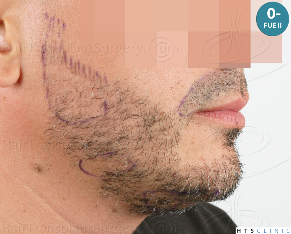 Dr.Devroye-HTS-Clinic-2191-Beard-FUE-16.