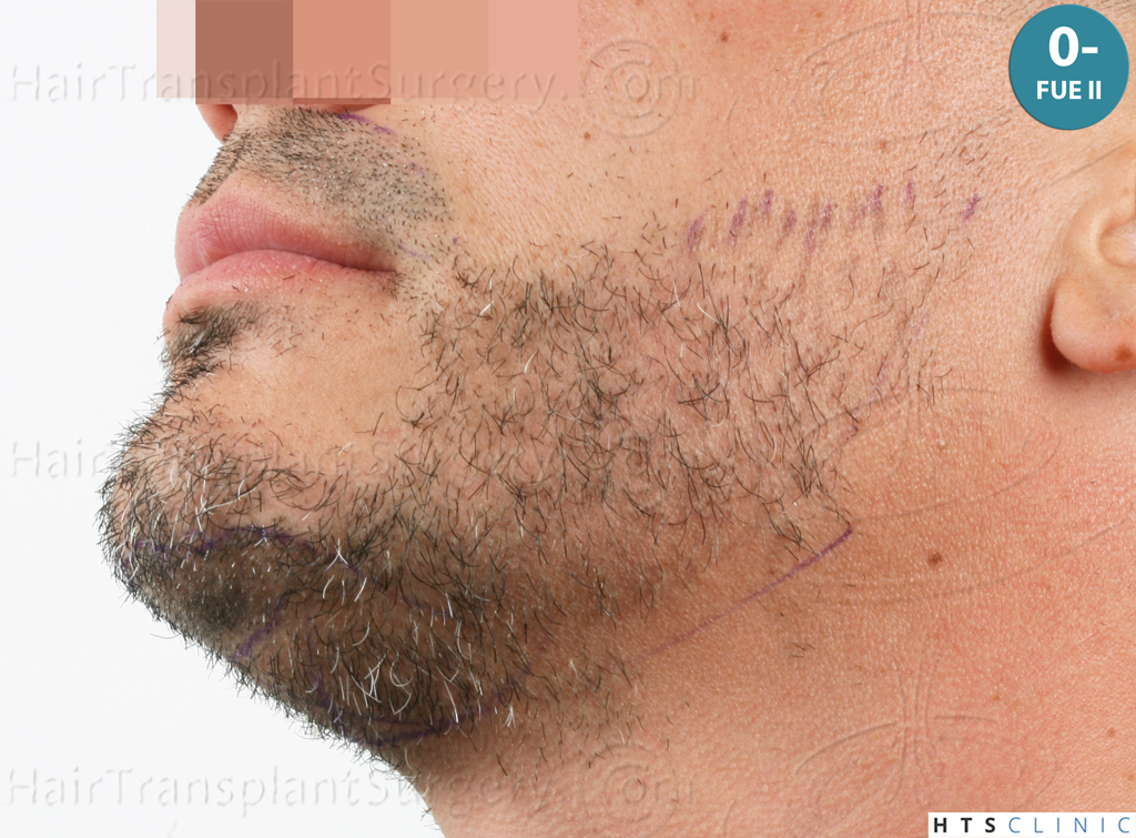 Dr.Devroye-HTS-Clinic-2191-Beard-FUE-15.