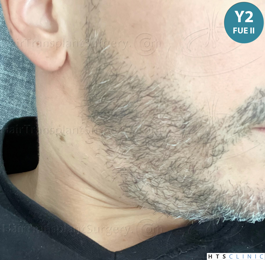 Dr.Devroye-HTS-Clinic-2191-Beard-FUE-24.