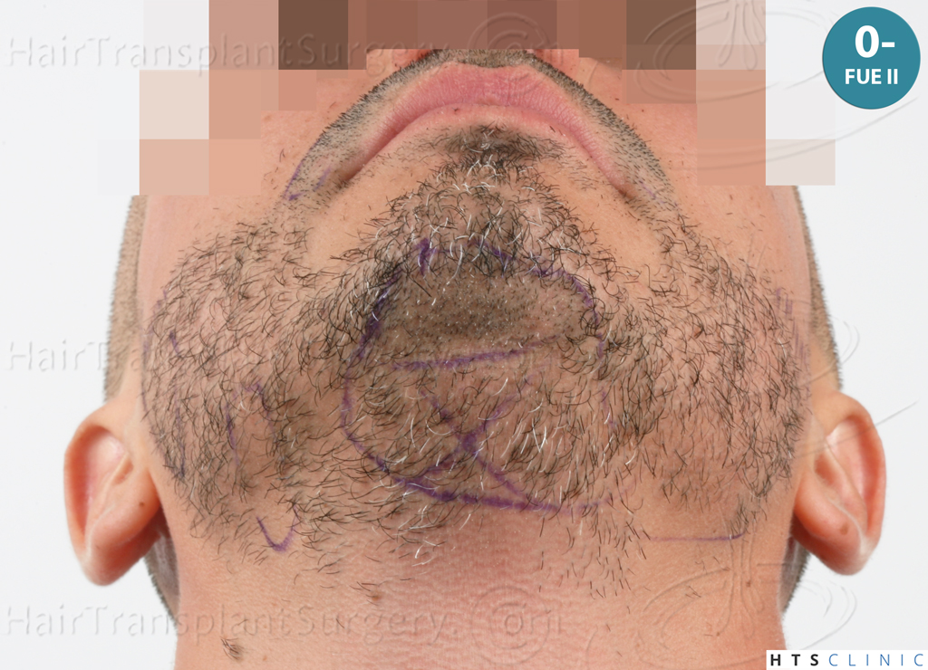 Dr.Devroye-HTS-Clinic-2191-Beard-FUE-17.