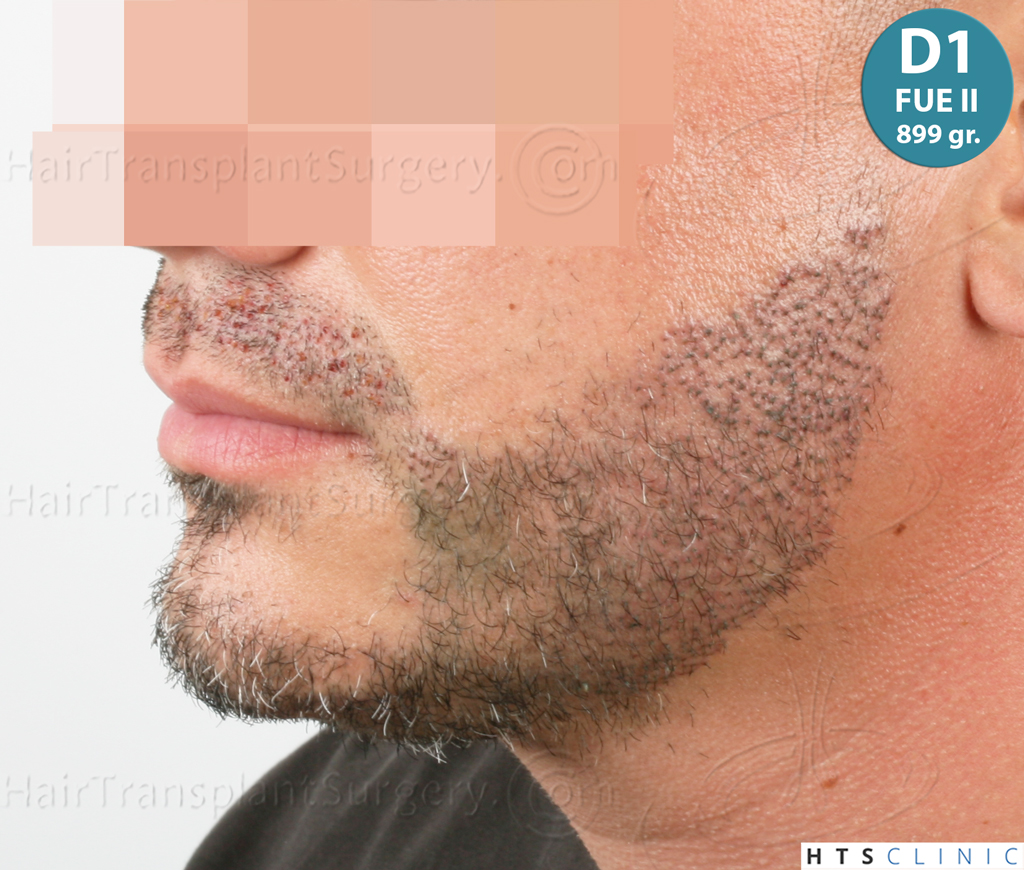 Dr.Devroye-HTS-Clinic-2191-Beard-FUE-19.