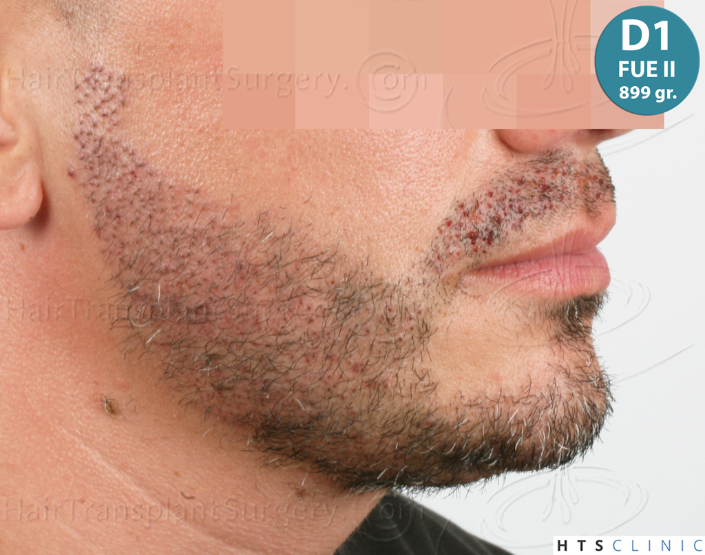 Dr.Devroye-HTS-Clinic-2191-Beard-FUE-20.