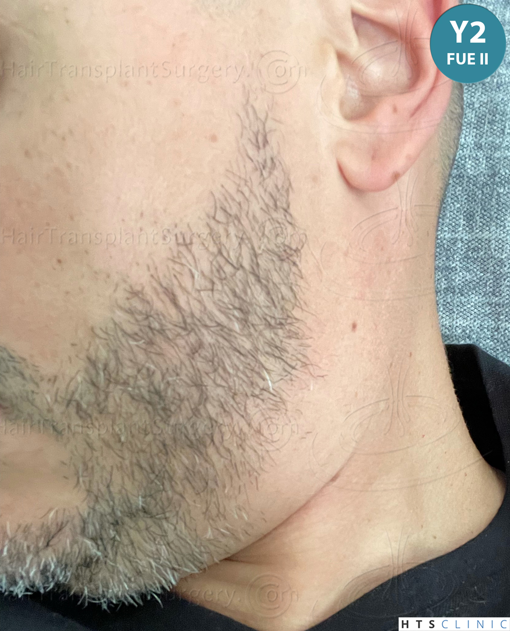 Dr.Devroye-HTS-Clinic-2191-Beard-FUE-23.