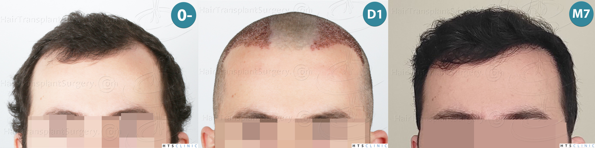 Dr.Devroye-HTS-Clinic-2101-FUE-Montage-1