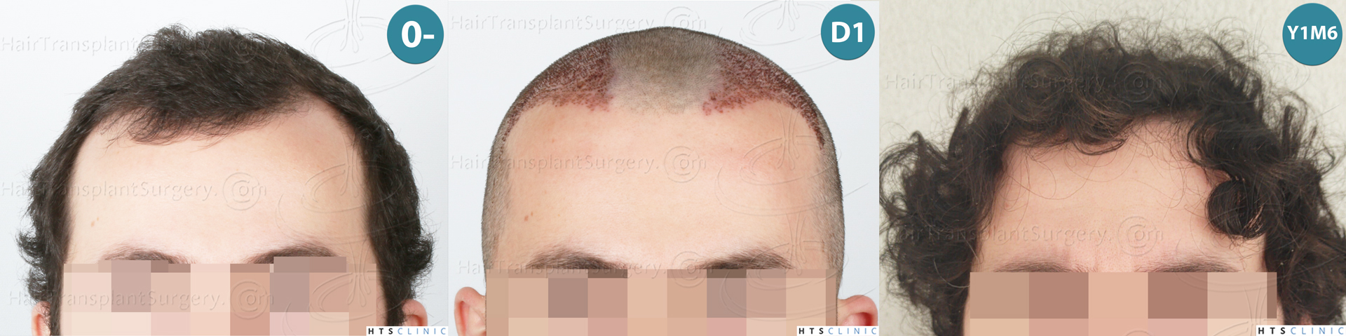 Dr.Devroye-HTS-Clinic-2101-FUE-Montage-2