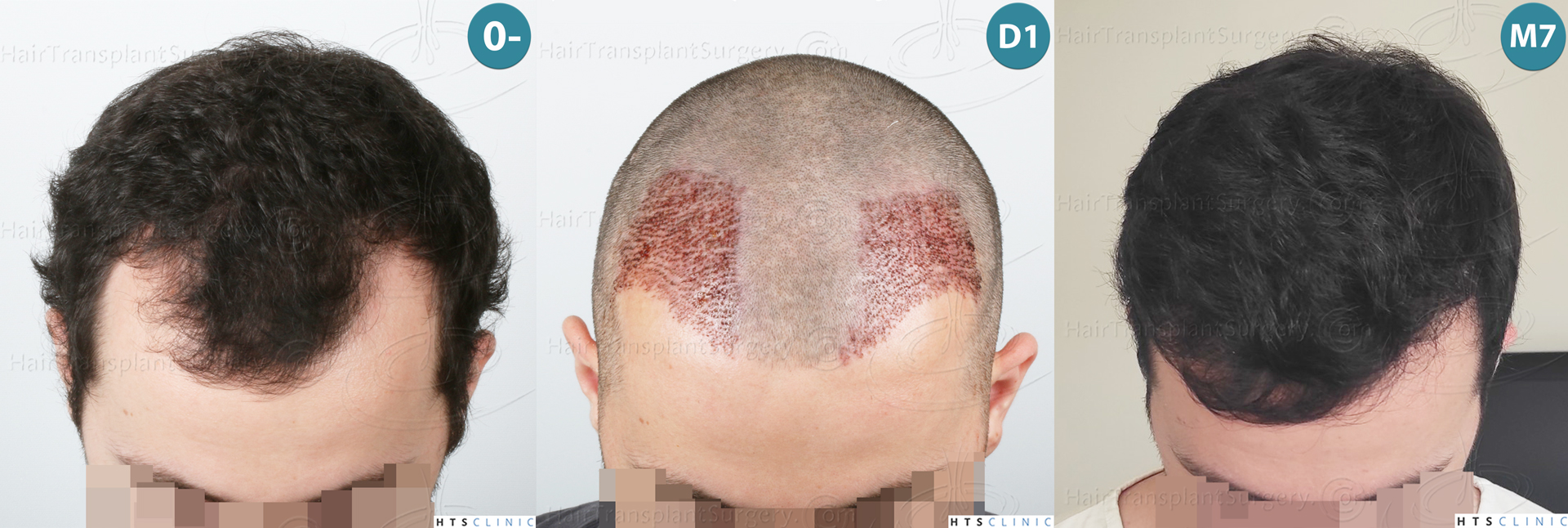 Dr.Devroye-HTS-Clinic-2101-FUE-Montage-3