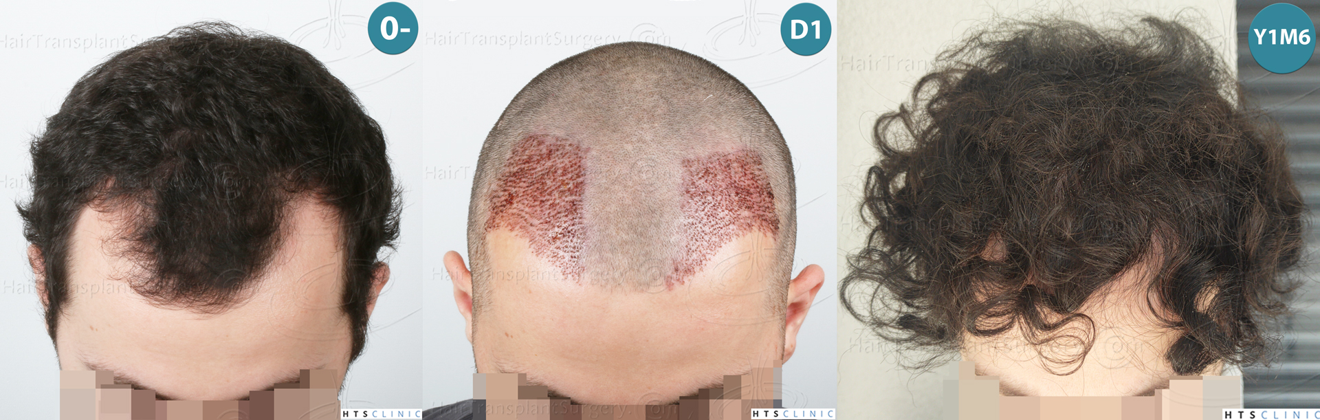 Dr.Devroye-HTS-Clinic-2101-FUE-Montage-4