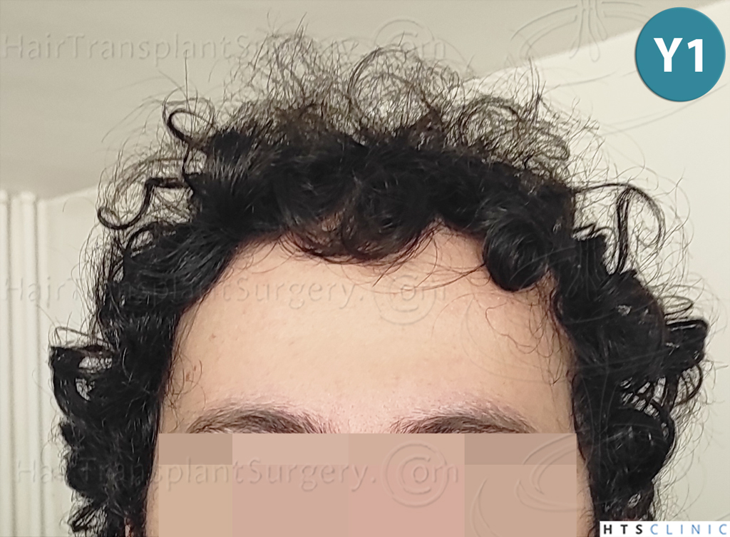 Dr.Devroye-HTS-Clinic-2101-FUE-30.jpg