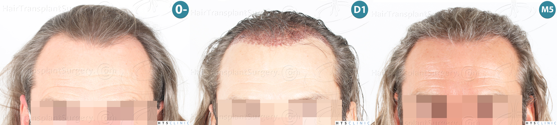 Dr.Devroye-Montesanti-Jenard-HTS-Clinic-2005-FUE-Montage-1.jpg