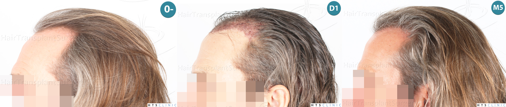 Dr.Devroye-Montesanti-Jenard-HTS-Clinic-2005-FUE-Montage-2.jpg