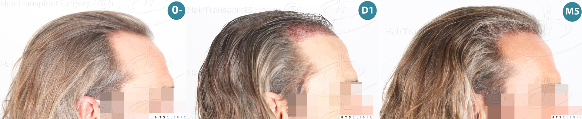 Dr.Devroye-Montesanti-Jenard-HTS-Clinic-2005-FUE-Montage-3.jpg