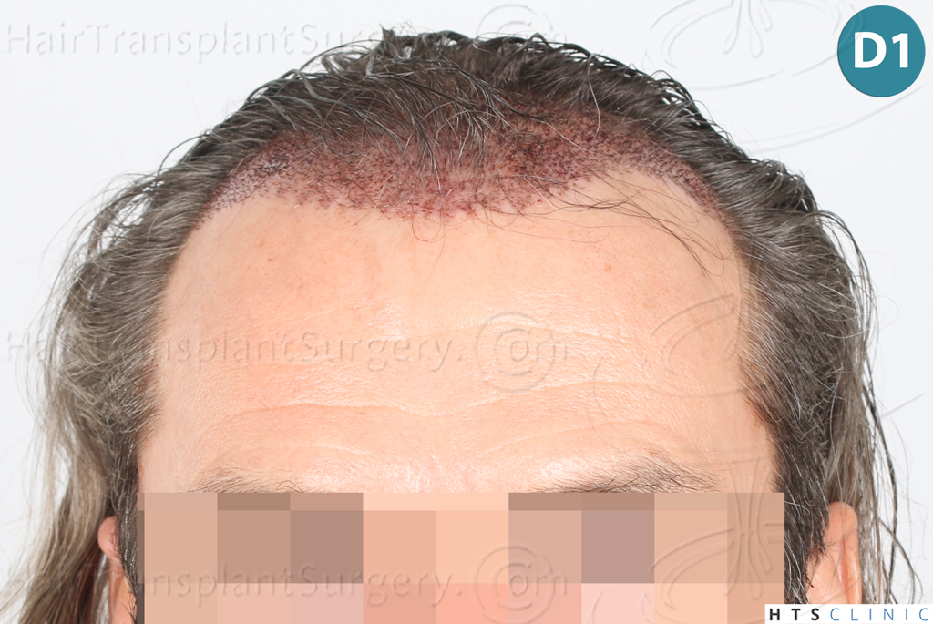 Dr.Devroye-Montesanti-Jenard-HTS-Clinic-2005-FUE-8