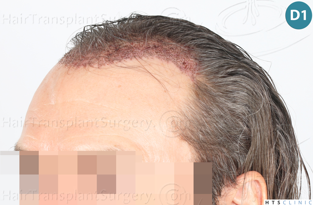 Dr.Devroye-Montesanti-Jenard-HTS-Clinic-2005-FUE-10