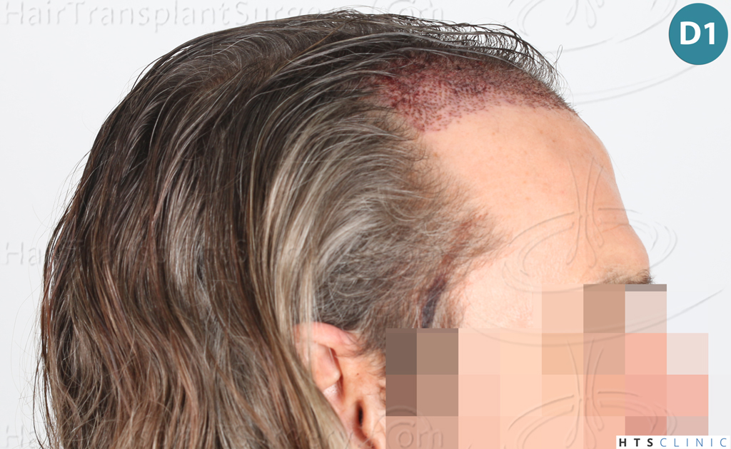 Dr.Devroye-Montesanti-Jenard-HTS-Clinic-2005-FUE-11.jpg