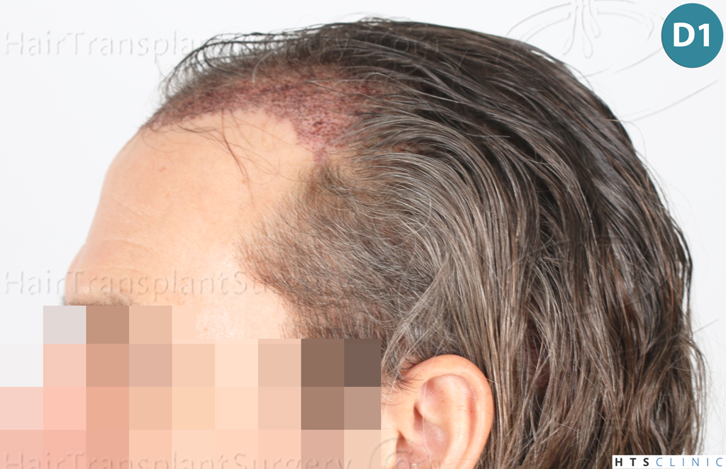 Dr.Devroye-Montesanti-Jenard-HTS-Clinic-2005-FUE-9.jpg