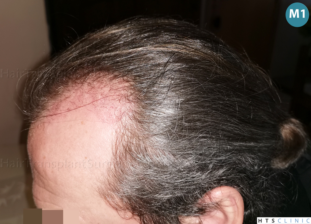 Dr.Devroye-Montesanti-Jenard-HTS-Clinic-2005-FUE-16.jpg