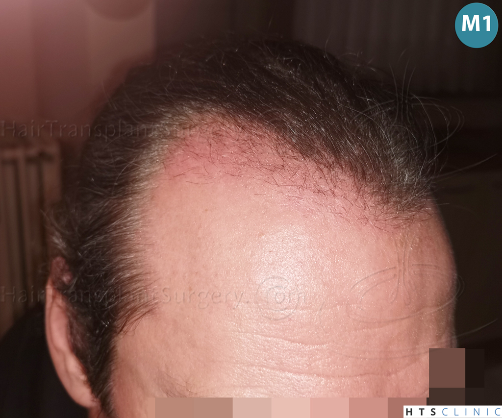 Dr.Devroye-Montesanti-Jenard-HTS-Clinic-2005-FUE-17.jpg