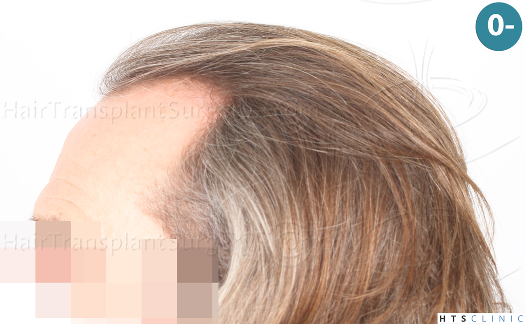 Dr.Devroye-Montesanti-Jenard-HTS-Clinic-2005-FUE-2.jpg
