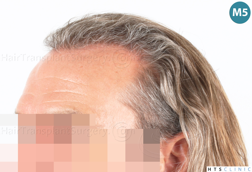 Dr.Devroye-Montesanti-Jenard-HTS-Clinic-2005-FUE-21.jpg