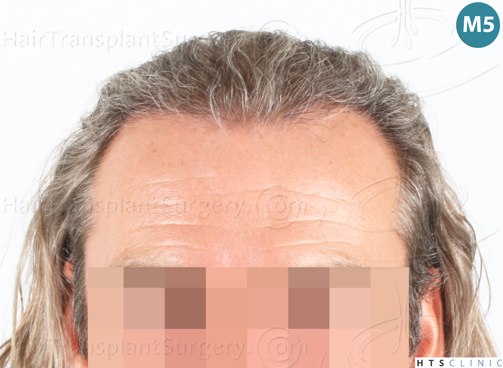 Dr.Devroye-Montesanti-Jenard-HTS-Clinic-2005-FUE-18.jpg