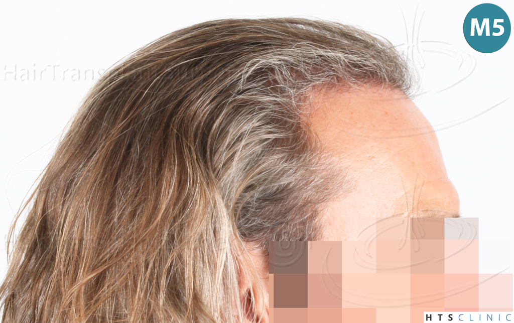Dr.Devroye-Montesanti-Jenard-HTS-Clinic-2005-FUE-22.jpg