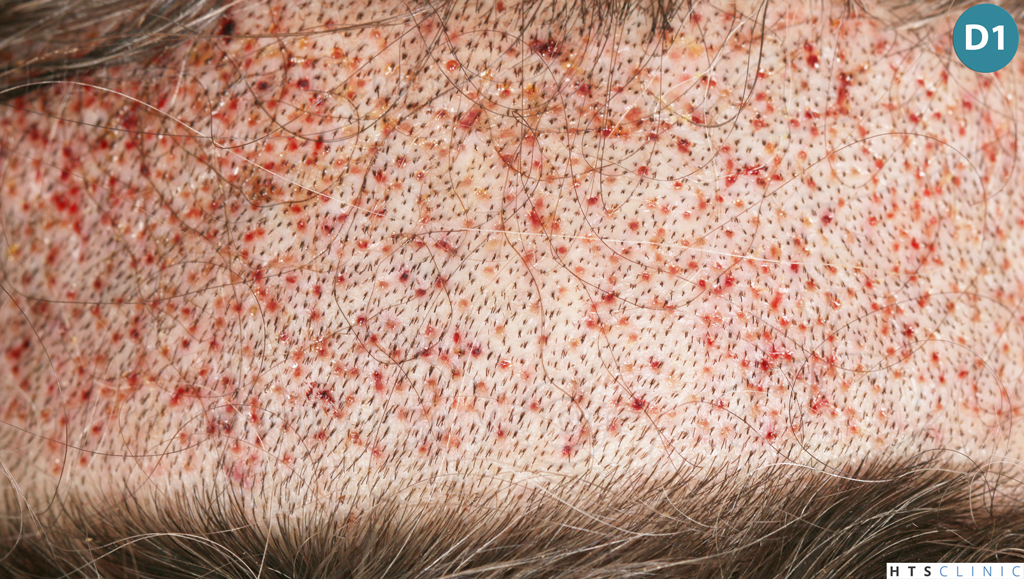 Dr.Devroye-Montesanti-Jenard-HTS-Clinic-2005-FUE-15.jpg