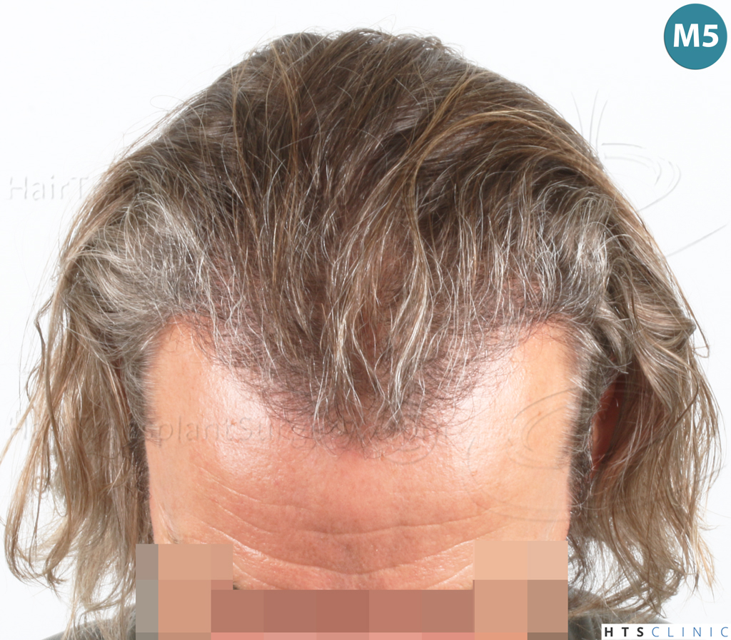Dr.Devroye-Montesanti-Jenard-HTS-Clinic-2005-FUE-19.jpg