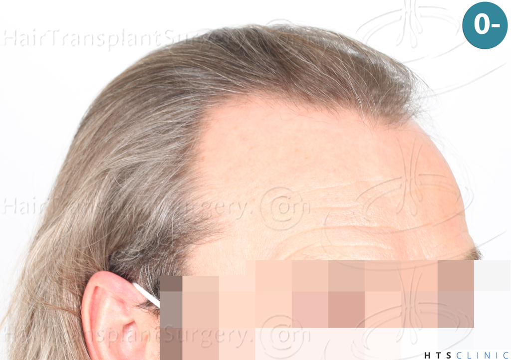 Dr.Devroye-Montesanti-Jenard-HTS-Clinic-2005-FUE-5.jpg