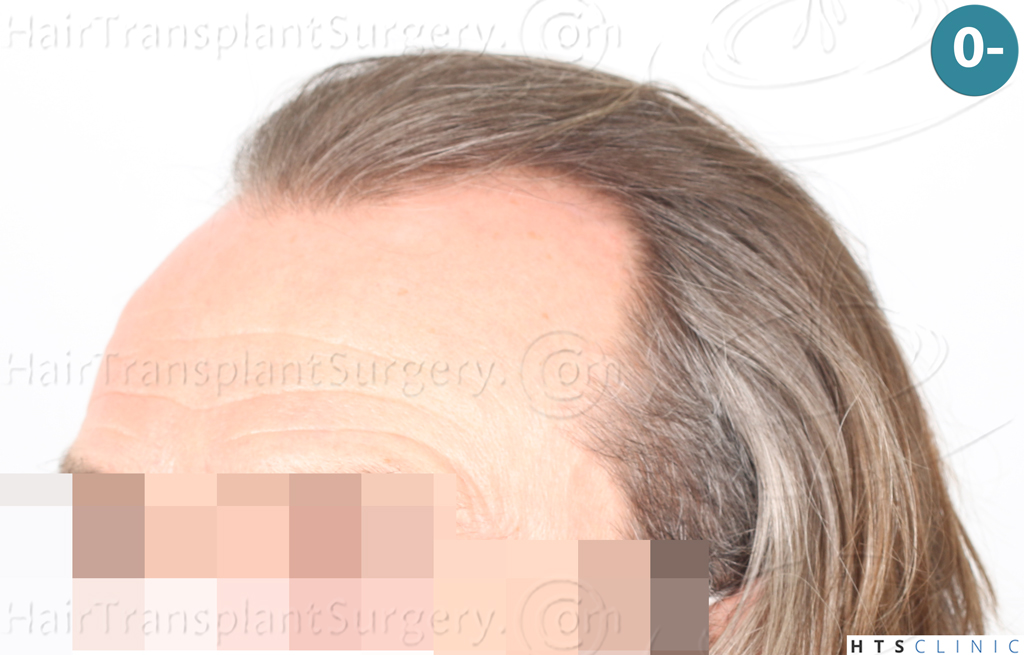 Dr.Devroye-Montesanti-Jenard-HTS-Clinic-2005-FUE-3.jpg