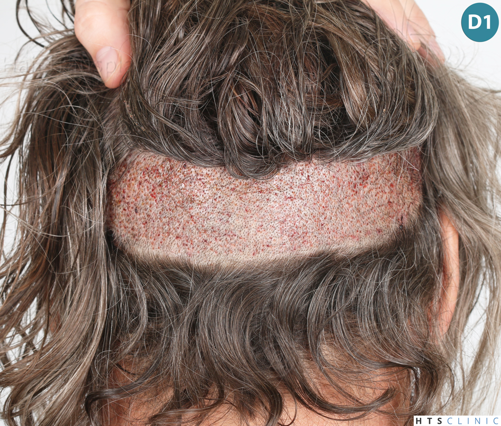 Dr.Devroye-Montesanti-Jenard-HTS-Clinic-2005-FUE-14.jpg