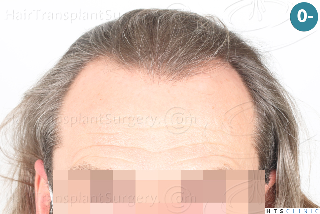 Dr.Devroye-Montesanti-Jenard-HTS-Clinic-2005-FUE-1.jpg