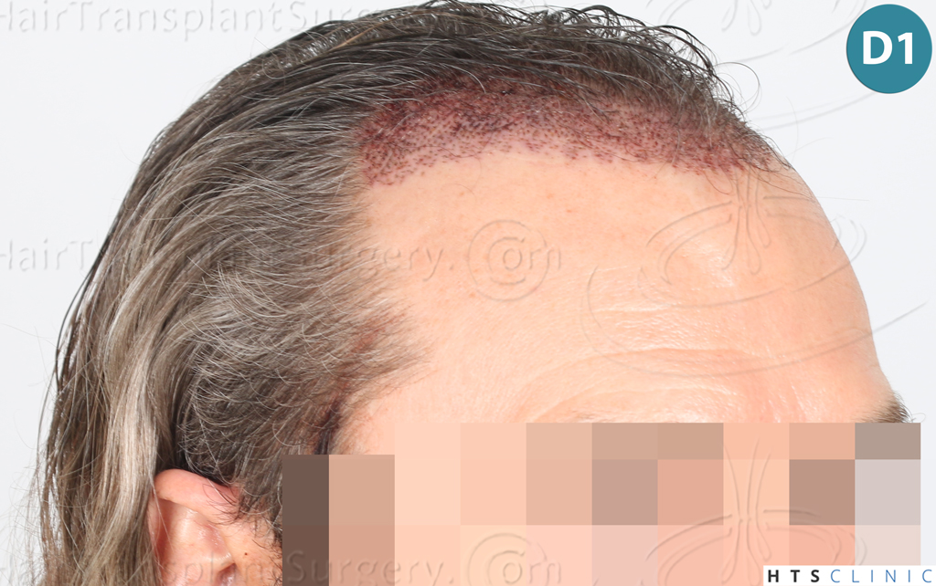 Dr.Devroye-Montesanti-Jenard-HTS-Clinic-2005-FUE-12.jpg