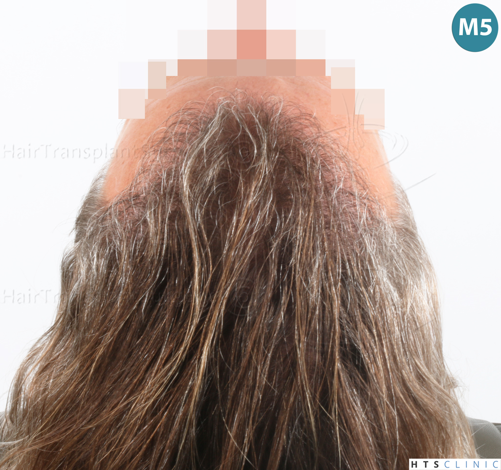 Dr.Devroye-Montesanti-Jenard-HTS-Clinic-2005-FUE-25.jpg