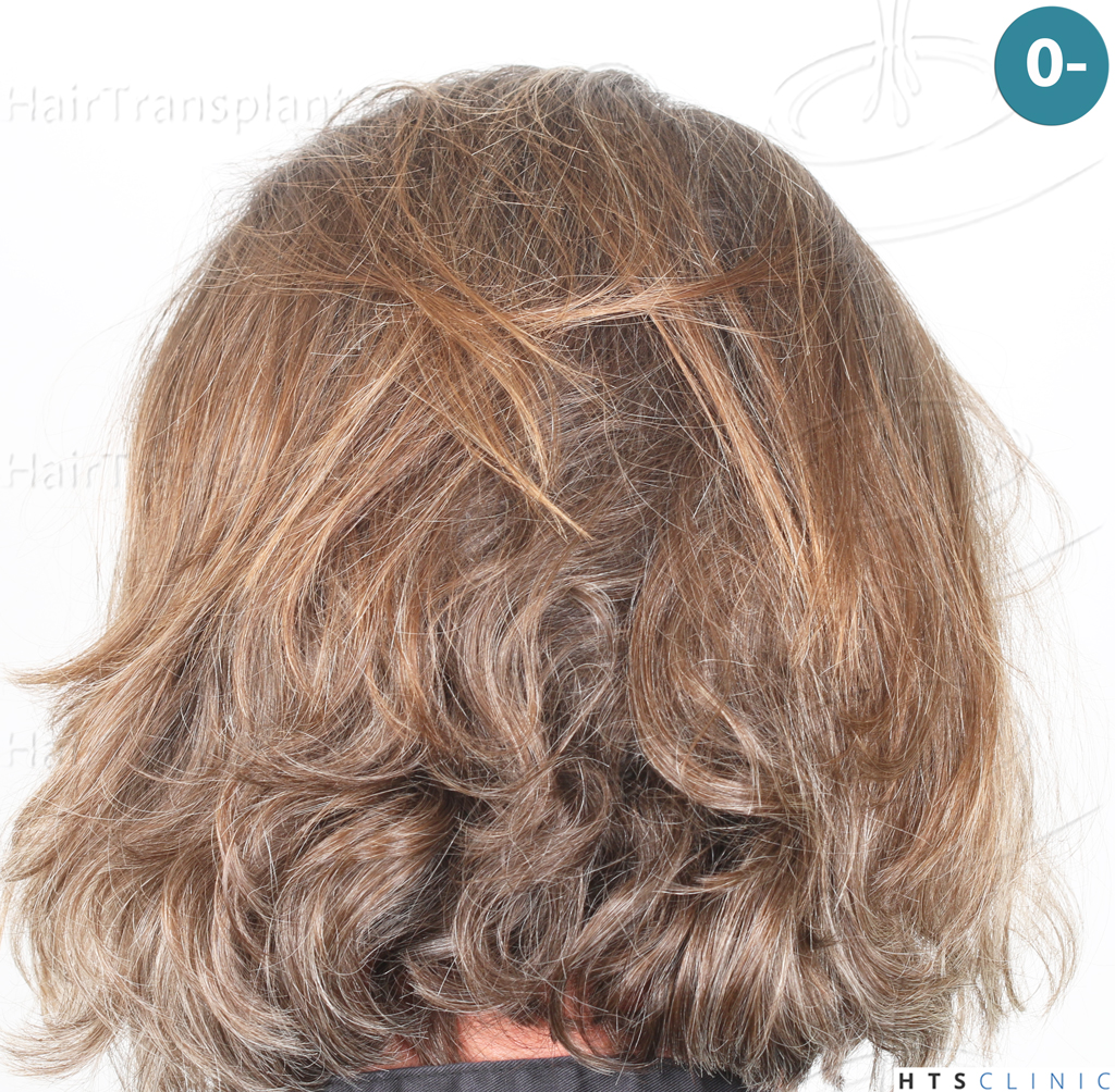Dr.Devroye-Montesanti-Jenard-HTS-Clinic-2005-FUE-6.jpg