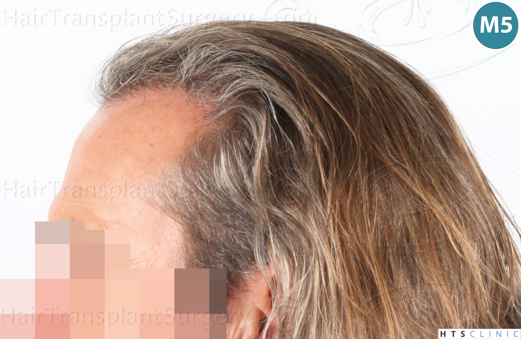 Dr.Devroye-Montesanti-Jenard-HTS-Clinic-2005-FUE-20.jpg