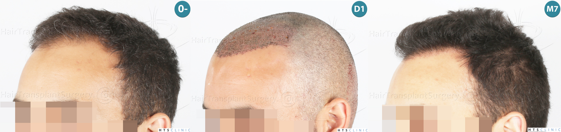 Dr.Devroye-Montesanti-Jenard-HTS-Clinic-2018-FUE-Montage-3.jpg