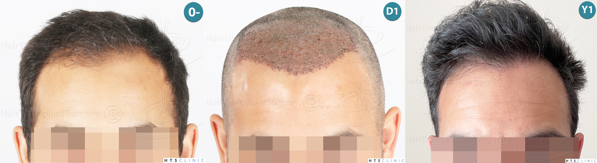 Dr.Devroye-Montesanti-Jenard-HTS-Clinic-2018-FUE-Montage-2.jpg
