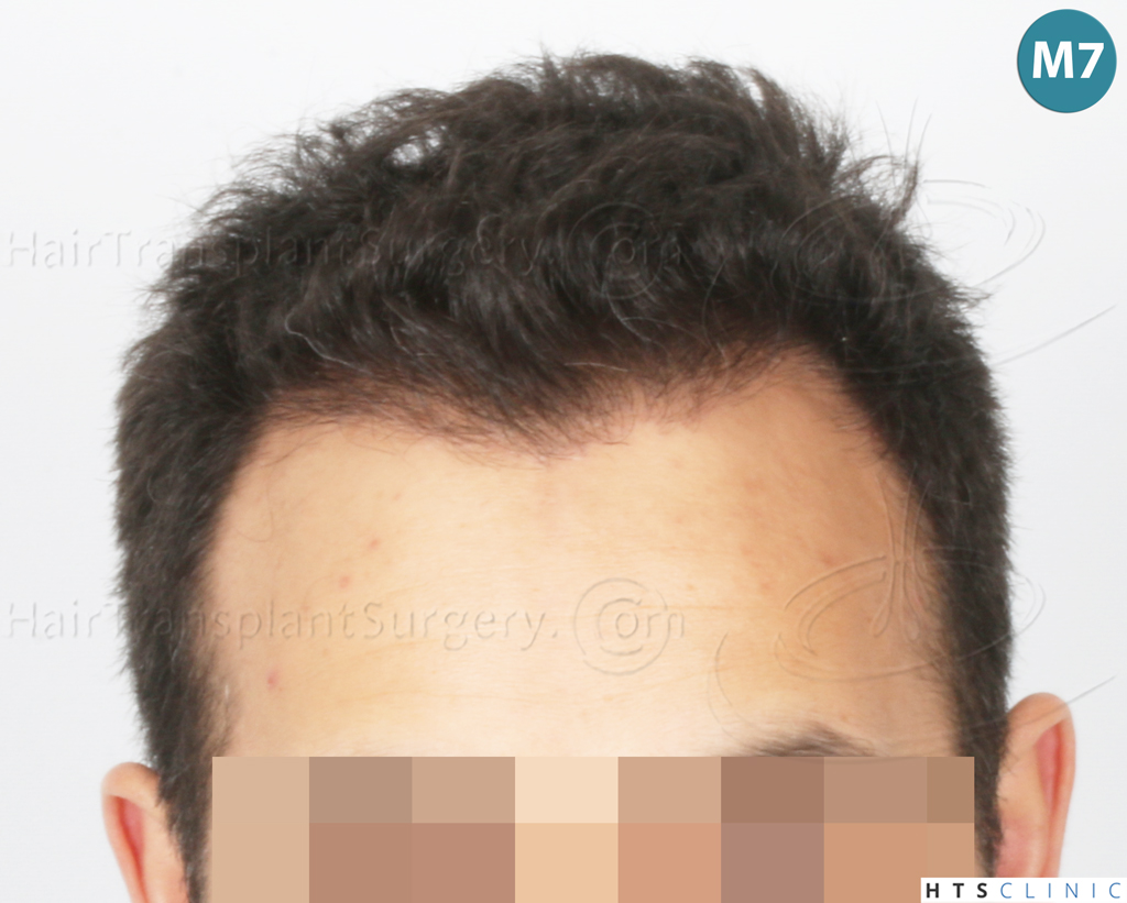 Dr.Devroye-Montesanti-Jenard-HTS-Clinic-2018-FUE-17.jpg