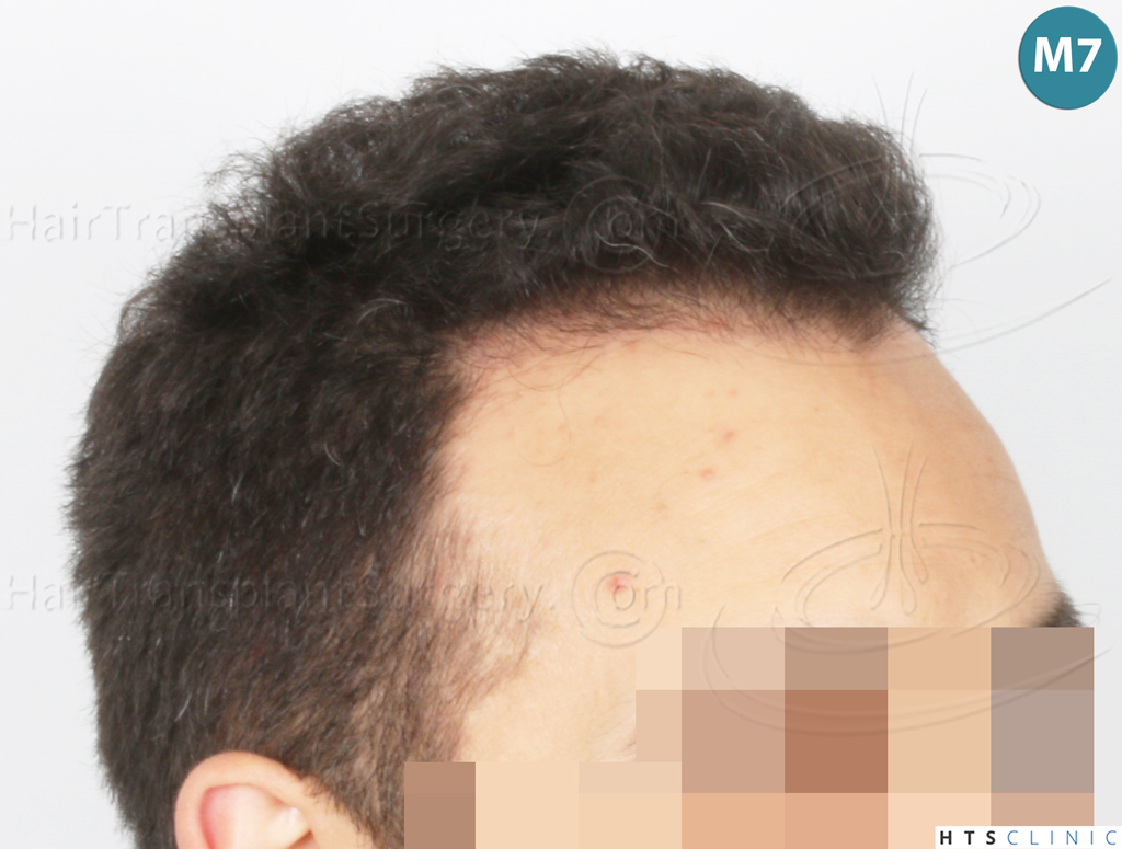 Dr.Devroye-Montesanti-Jenard-HTS-Clinic-2018-FUE-21.jpg