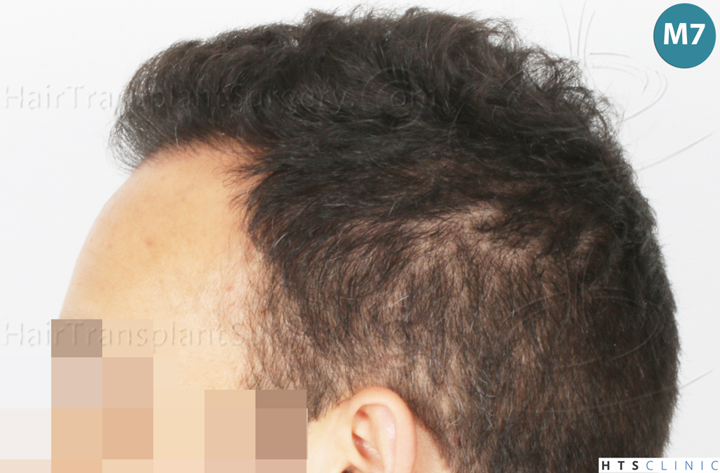 Dr.Devroye-Montesanti-Jenard-HTS-Clinic-2018-FUE-18.jpg