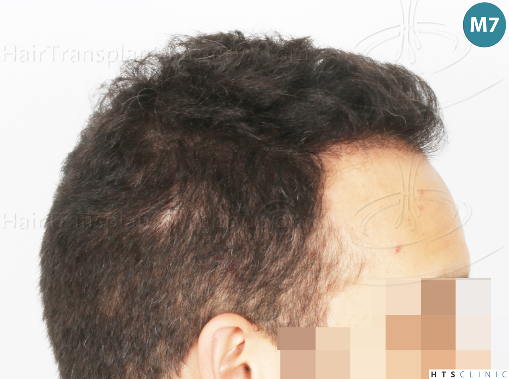 Dr.Devroye-Montesanti-Jenard-HTS-Clinic-2018-FUE-20.jpg