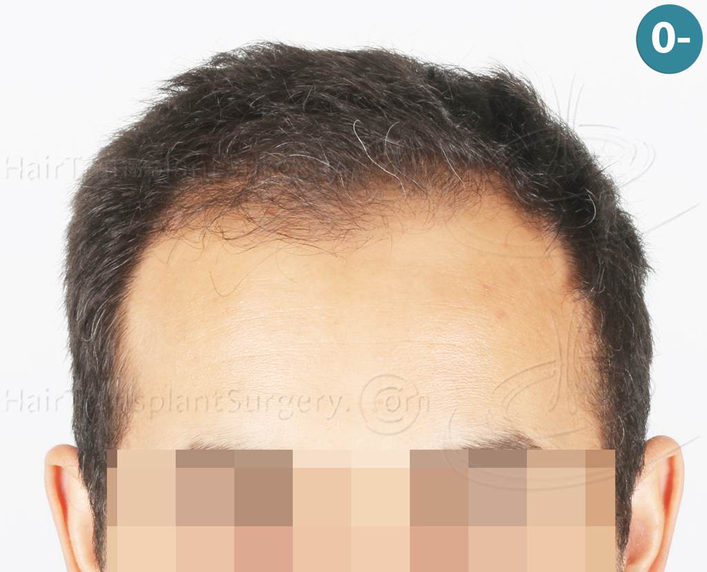 Dr.Devroye-Montesanti-Jenard-HTS-Clinic-2018-FUE-1.jpg