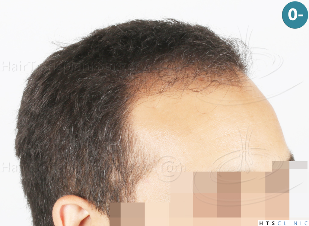 Dr.Devroye-Montesanti-Jenard-HTS-Clinic-2018-FUE-5.jpg
