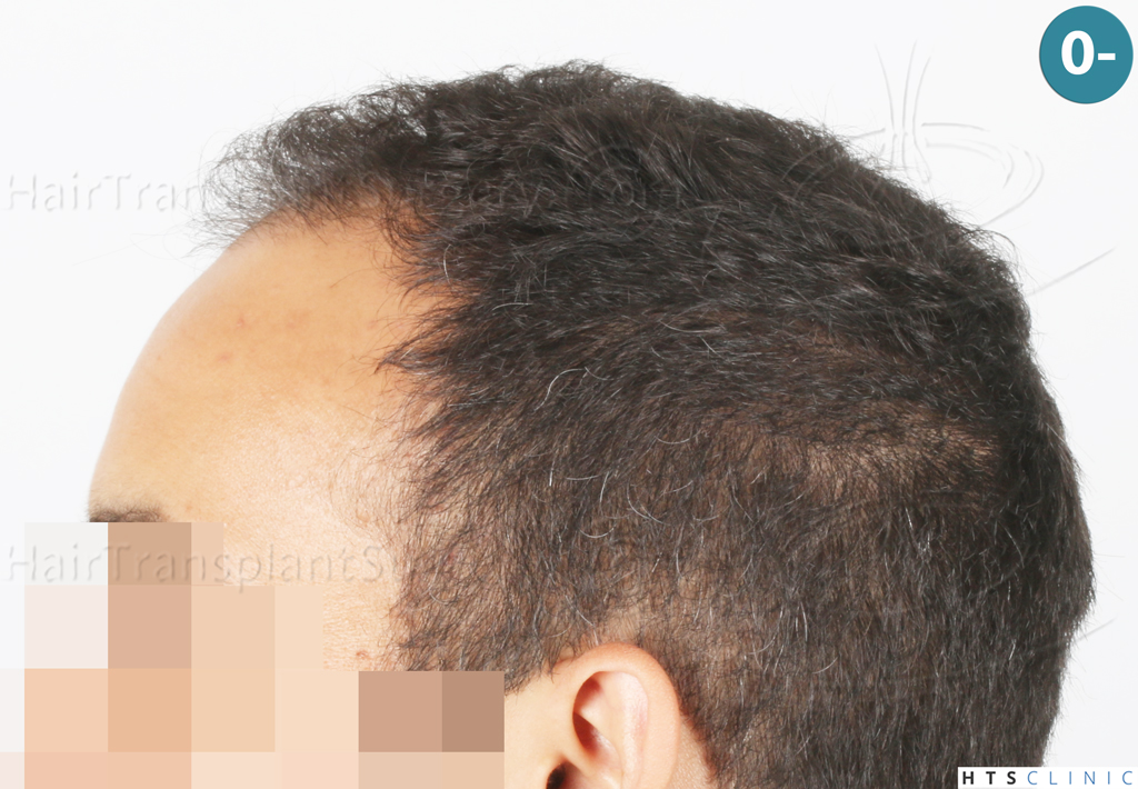 Dr.Devroye-Montesanti-Jenard-HTS-Clinic-2018-FUE-2.jpg