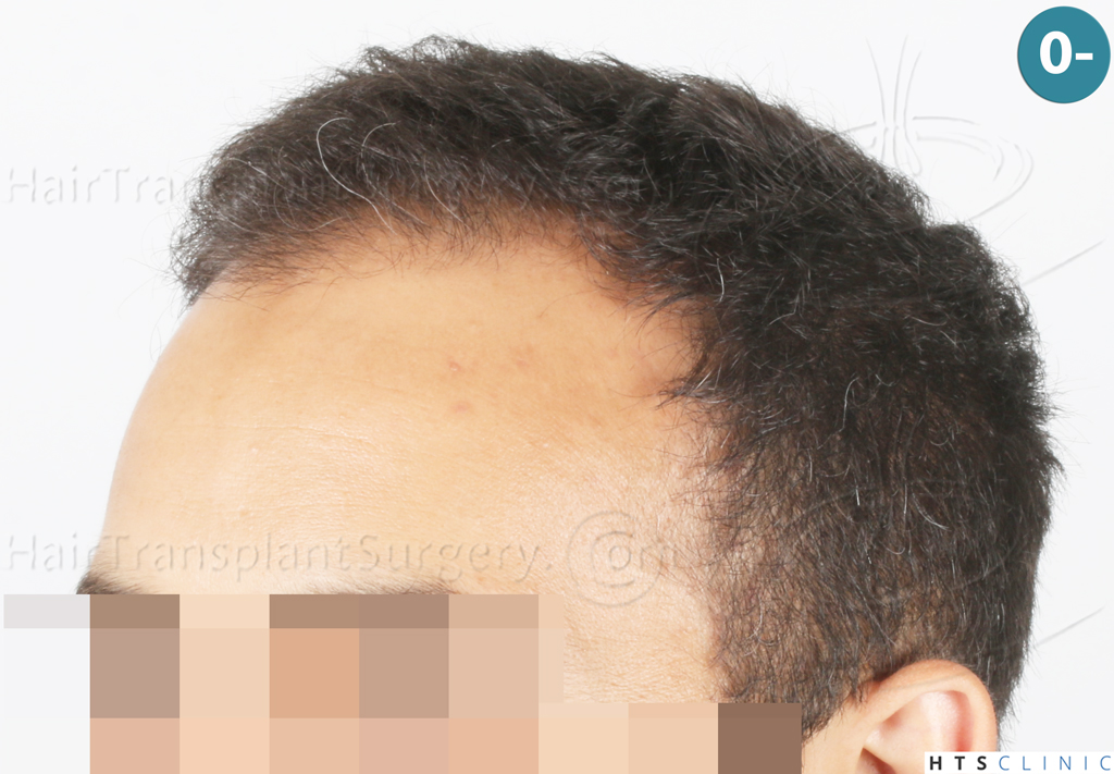 Dr.Devroye-Montesanti-Jenard-HTS-Clinic-2018-FUE-3.jpg