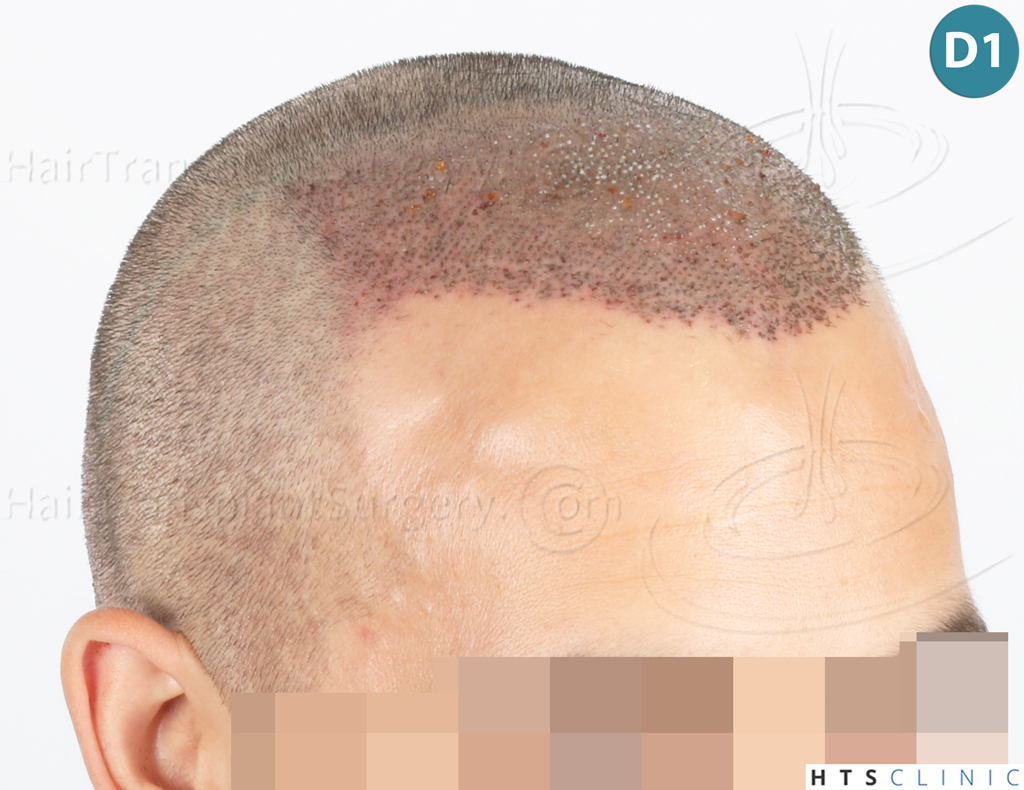 Dr.Devroye-Montesanti-Jenard-HTS-Clinic-2018-FUE-12.jpg