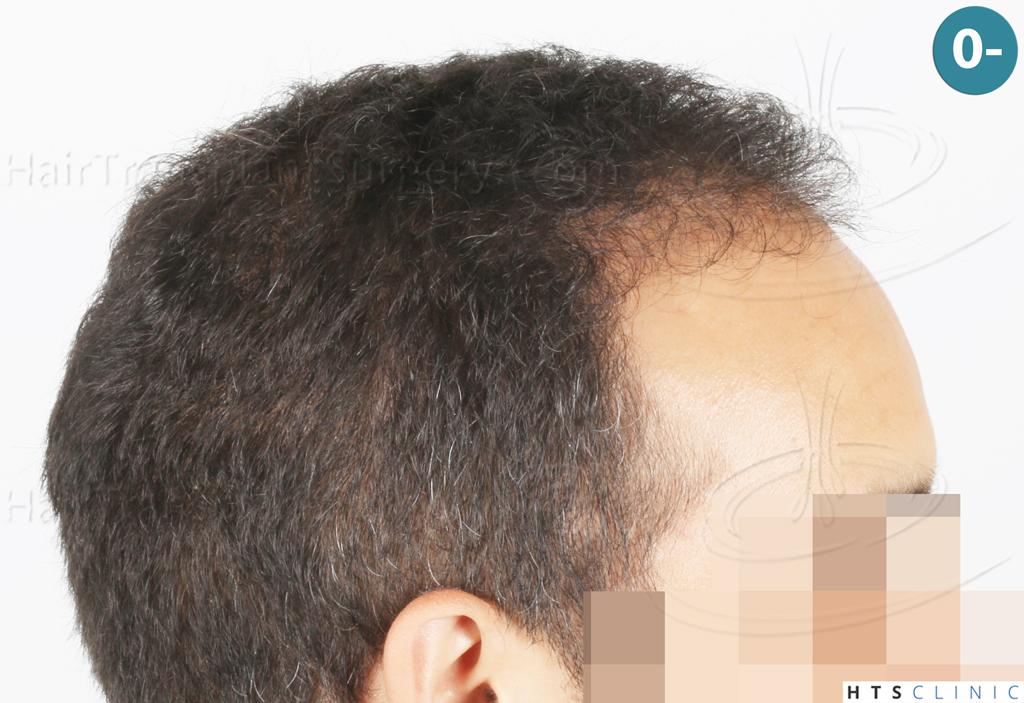 Dr.Devroye-Montesanti-Jenard-HTS-Clinic-2018-FUE-4.jpg