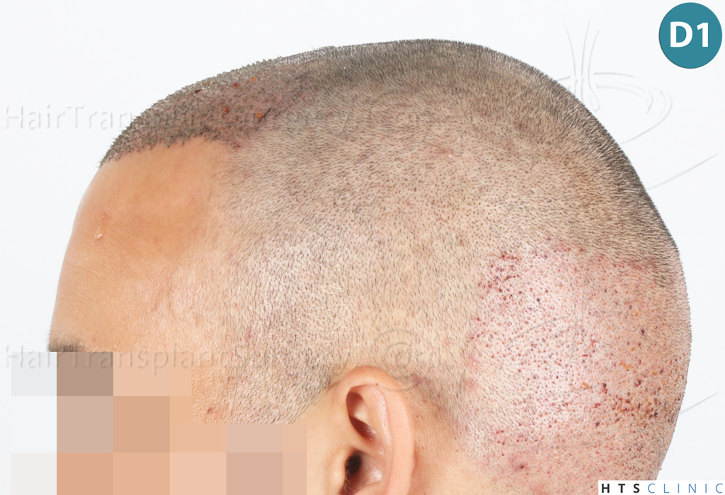 Dr.Devroye-Montesanti-Jenard-HTS-Clinic-2018-FUE-9.jpg