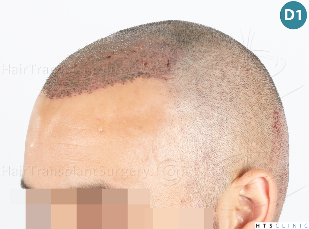 Dr.Devroye-Montesanti-Jenard-HTS-Clinic-2018-FUE-10.jpg