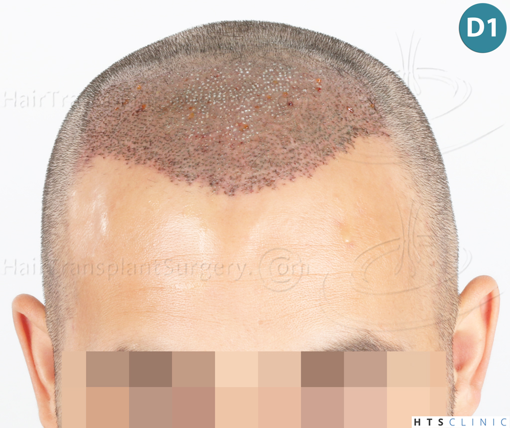 Dr.Devroye-Montesanti-Jenard-HTS-Clinic-2018-FUE-8.jpg